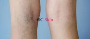 What are varicose veins?