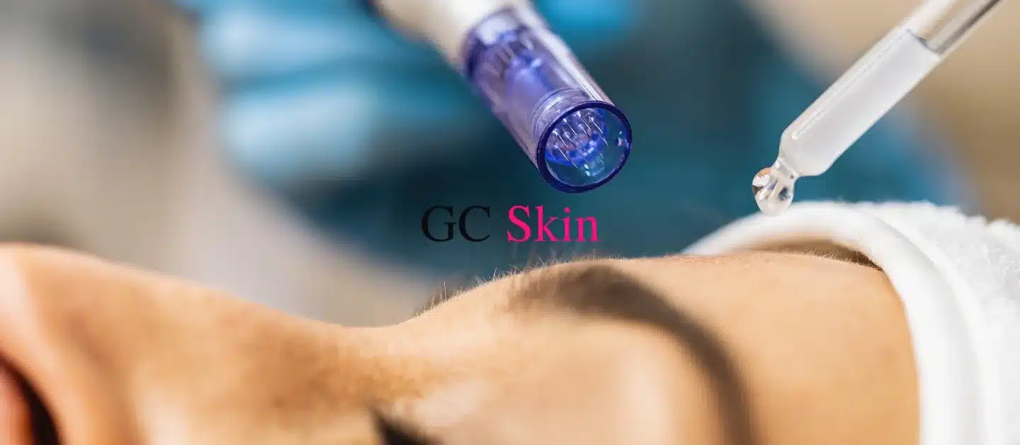 How does microneedling work?