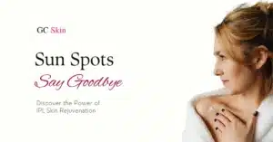 por qué el ipl es el tratamiento láser número 1 en GC Skin Medspa en Sherman Oaks