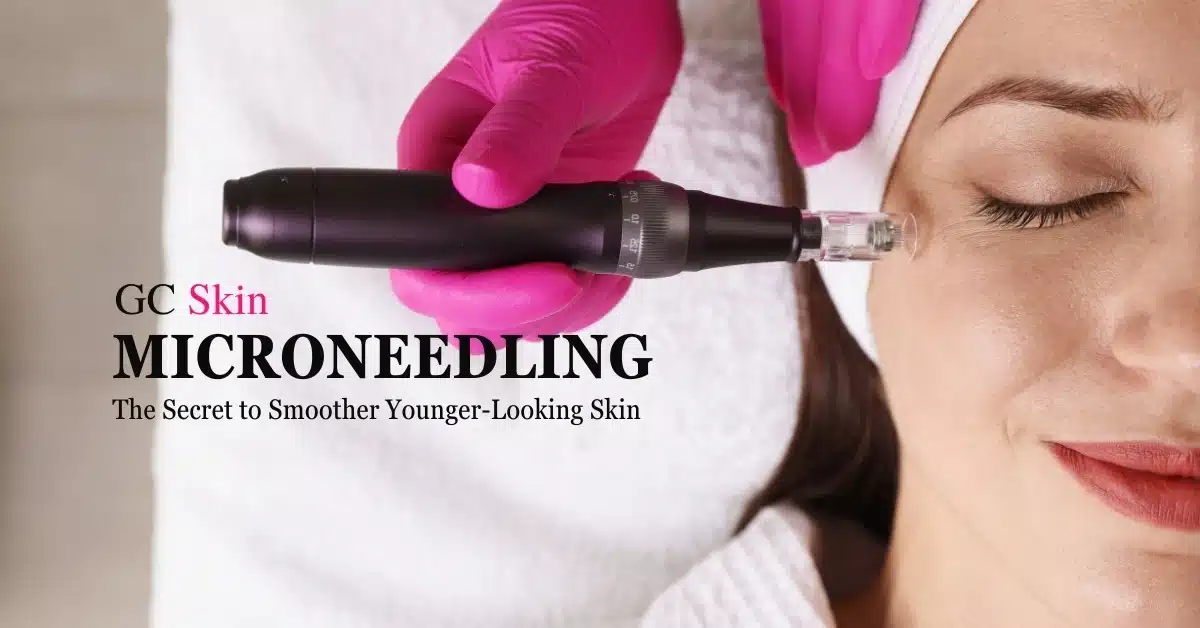 Microneedling en Sherman Oaks: El secreto de una piel más suave y joven