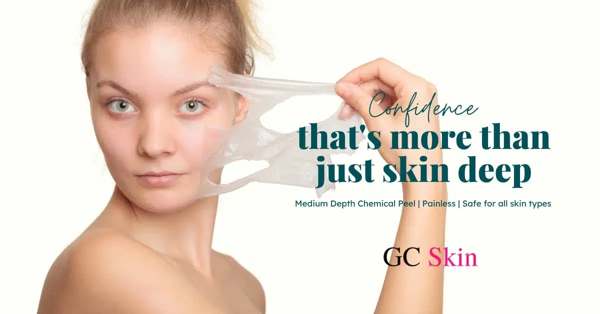 VI Peeling en Sherman Oaks: Lo último en rejuvenecimiento de la piel en GC Skin Medspa